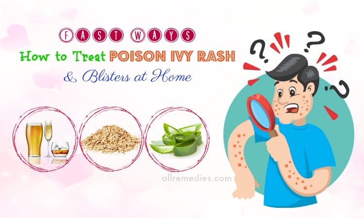 how to treat poison ivy