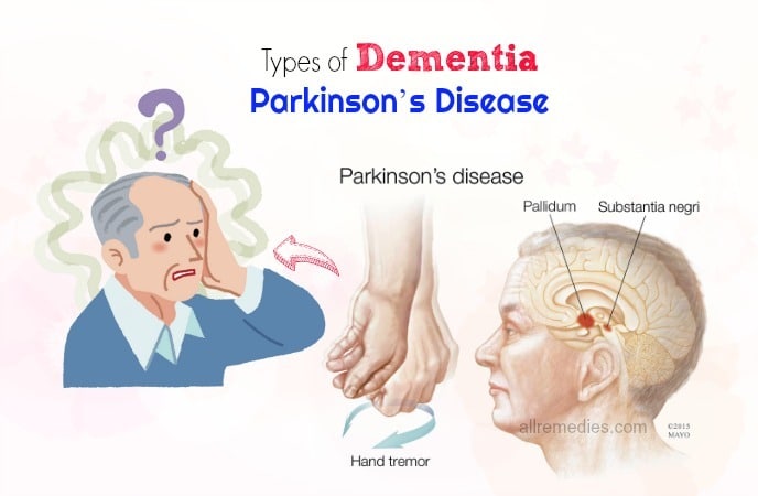 can dementia be linked to parkinsons disease