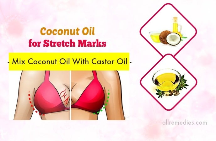 coconut oil for stretch marks removal