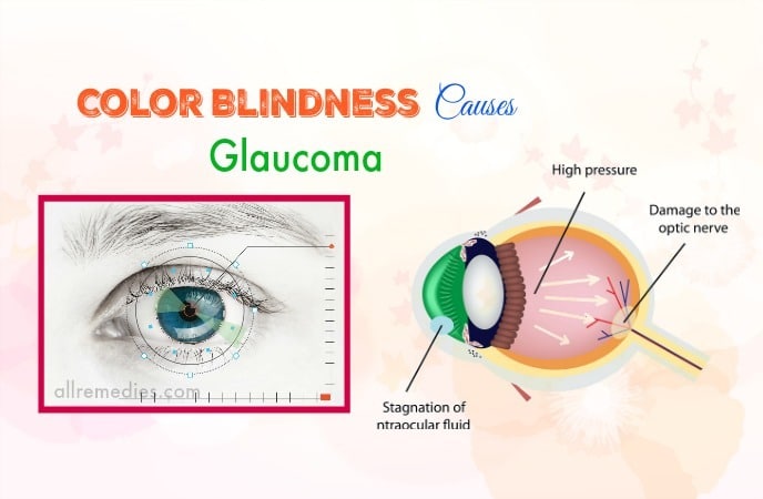 common color blindness causes