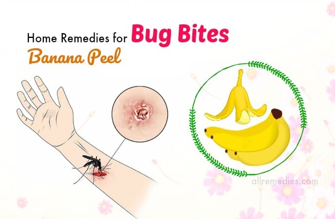 home remedies for bug bites
