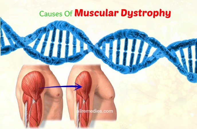 muscular dystrophy treatment