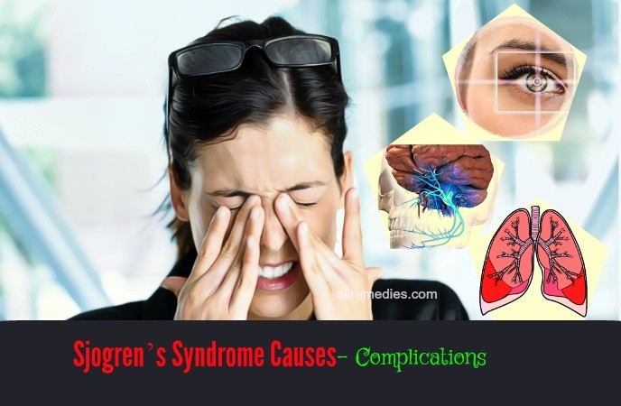 sjogren syndrome causes