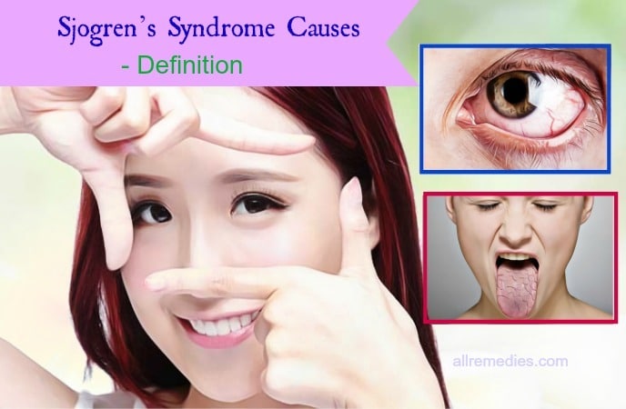sjogren syndrome causes