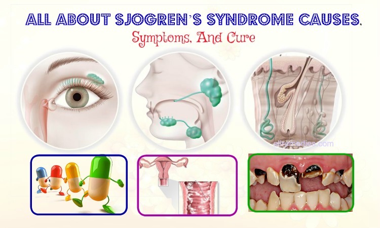 sjogren syndrome causes