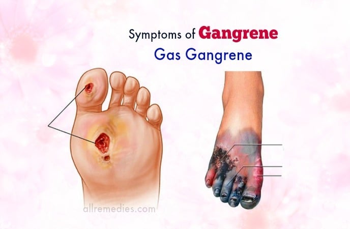 Symptoms of foot gangrene