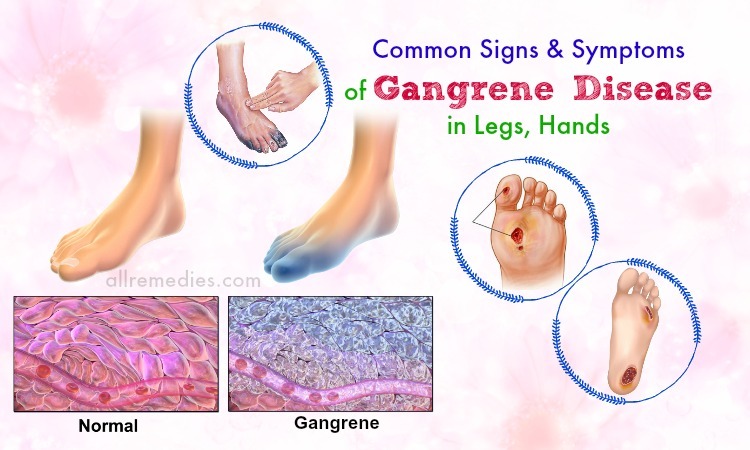 symptoms of gangrene